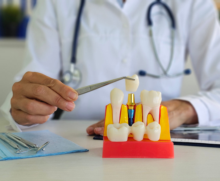 Why Choose David Suh Dental All-On-X?